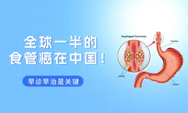 全球一半的食管癌在中(zhōng)國(guó)!早診早治是關鍵